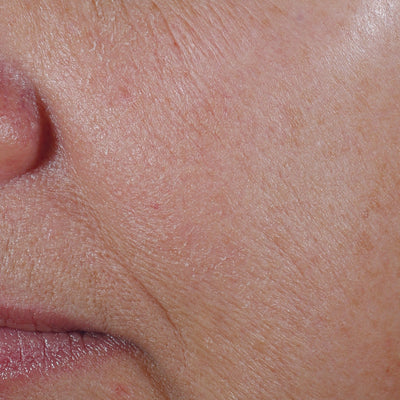 Close-up of a persons face showing skin texture with visible fine lines, wrinkles, and some dryness around the nose and mouth area.Before
