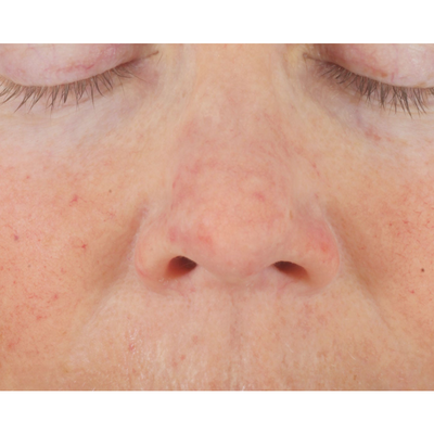 Close-up view of a persons nose and upper cheeks with closed eyes, showing light skin with some redness, visible pores, and minor blemishes. After