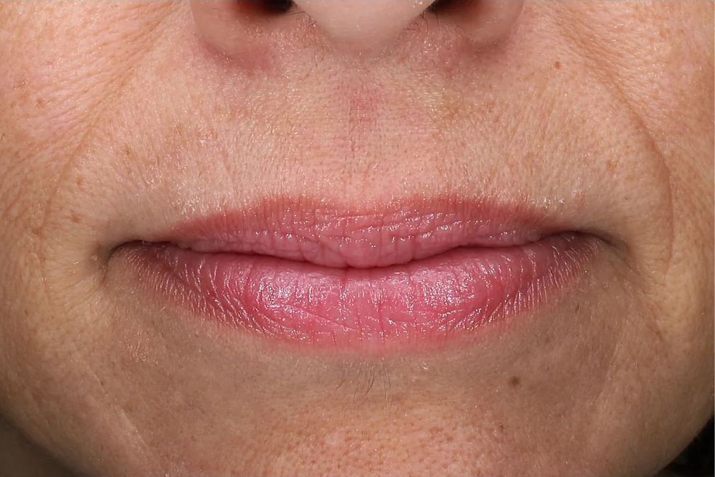 The Power of Revox™ Line Relaxer