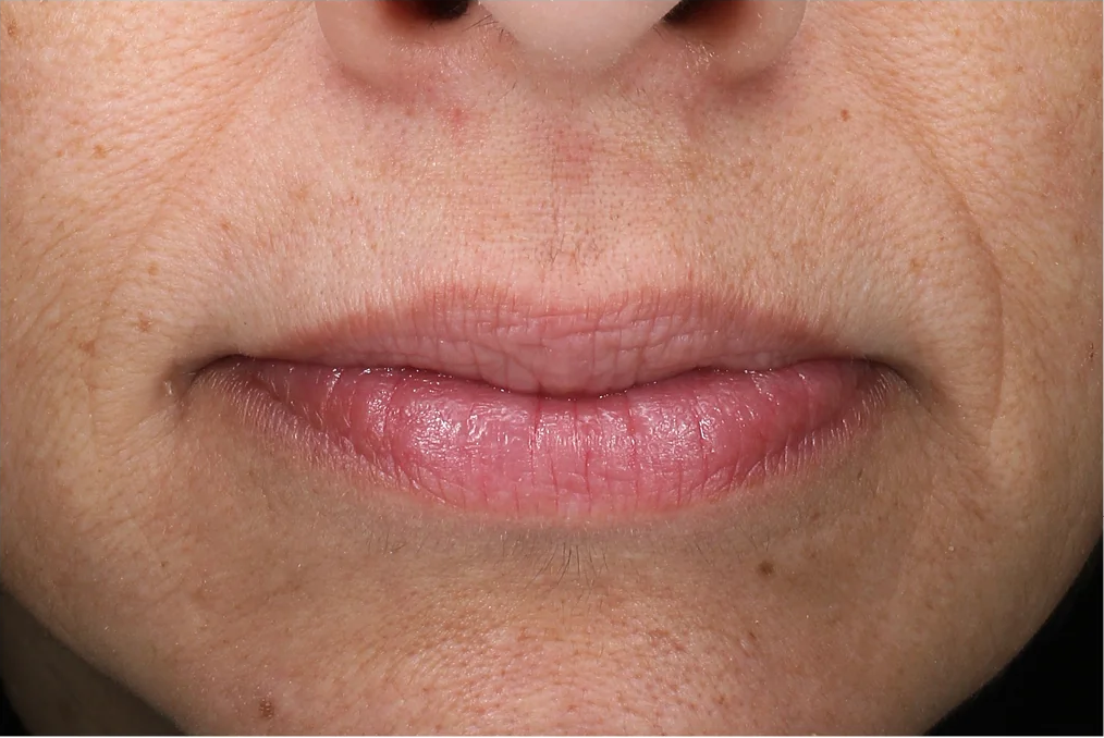 The Power of Revox™ Line Relaxer