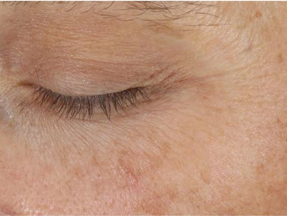 A comprehensive eye treatment inspired by the Dermal-Epidermal Junction(DEJ) that is clinically-proven to rejuvenate the total eye area