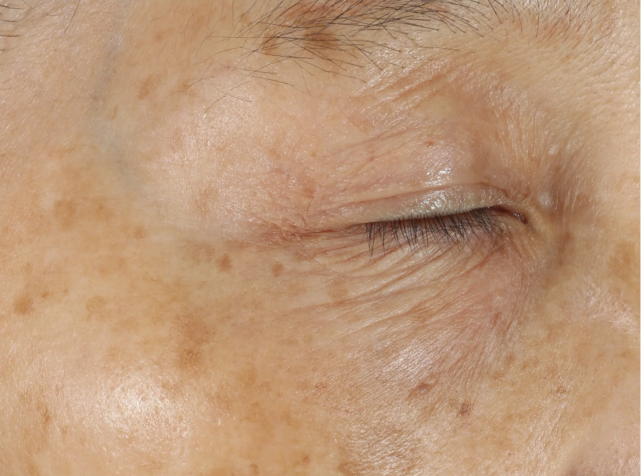 A comprehensive eye treatment inspired by the Dermal-Epidermal Junction(DEJ) that is clinically-proven to rejuvenate the total eye area