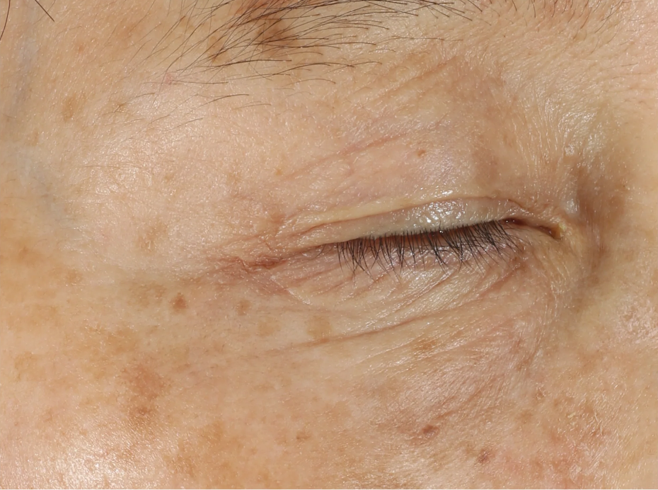 A comprehensive eye treatment inspired by the Dermal-Epidermal Junction(DEJ) that is clinically-proven to rejuvenate the total eye area