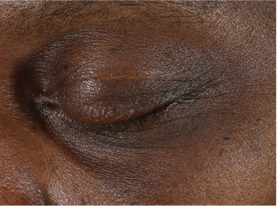 A comprehensive eye treatment inspired by the Dermal-Epidermal Junction(DEJ) that is clinically-proven to rejuvenate the total eye area