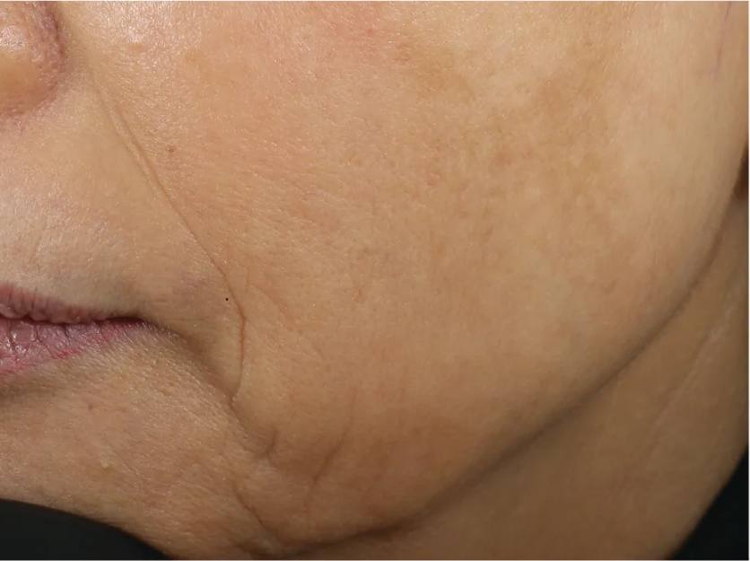 An advanced skin-renewing moisturizer that firms, lifts and smooths the skin utilizing a comprehensive, one-of-a-kind formula to deliver clinically-proven results