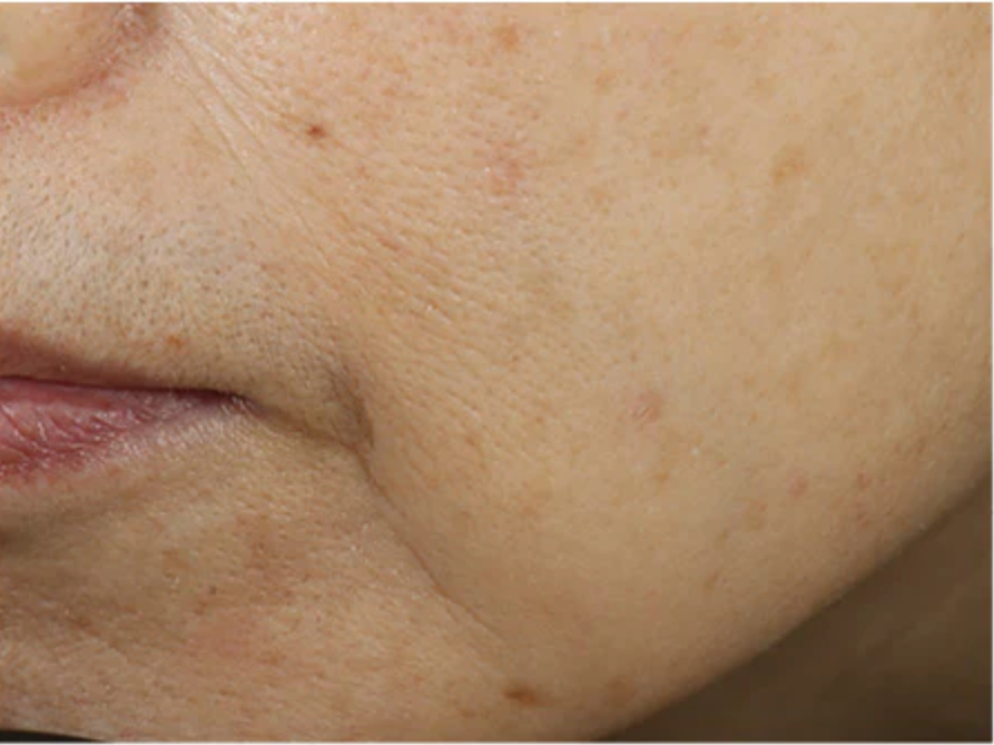 An advanced skin-renewing moisturizer that firms, lifts and smooths the skin utilizing a comprehensive, one-of-a-kind formula to deliver clinically-proven results