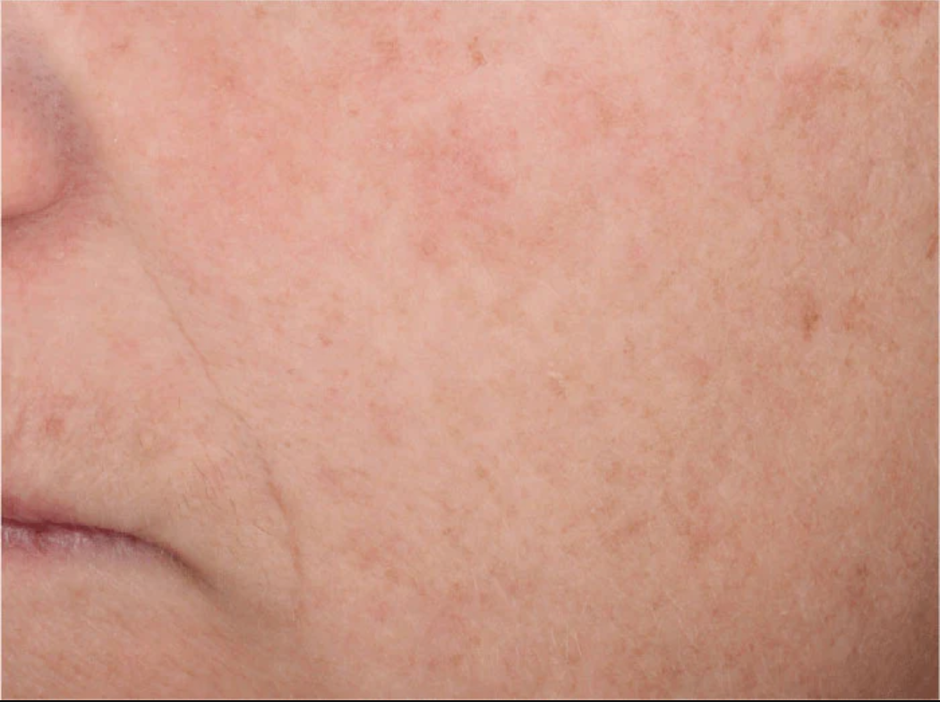 A 5-in-1 daily anti-aging tinted moisturizer with broad-spectrum SPF 45 that is formulated to correct, protect, conceal, brighten and hydrate skin