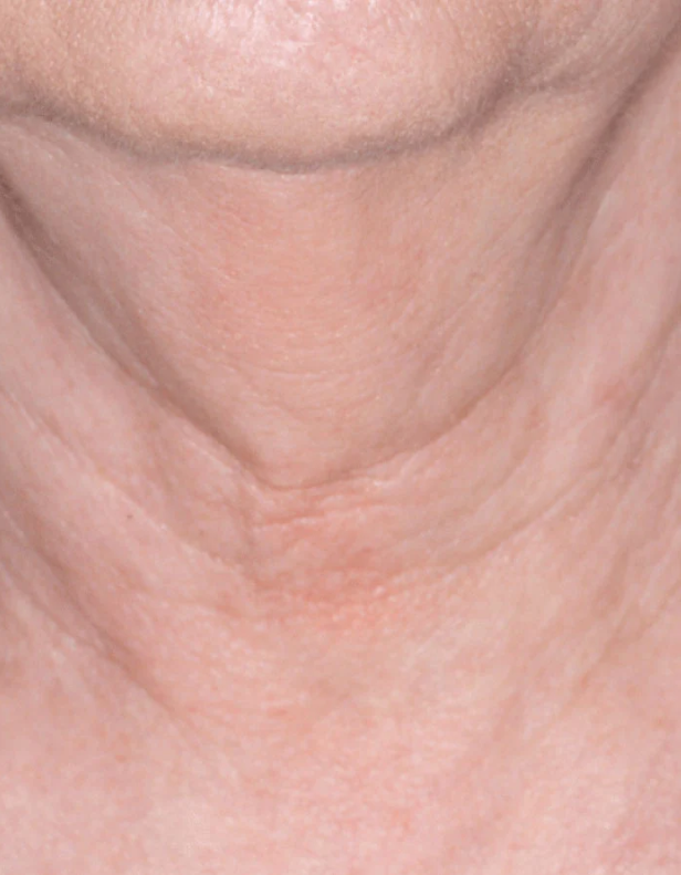 proven technology for firming the appearance of the neck