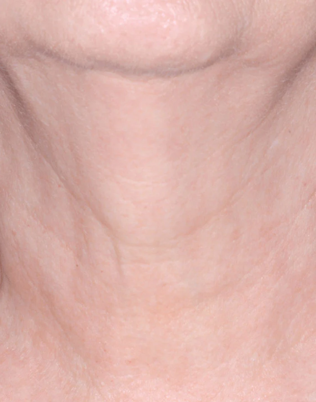 proven technology for firming the appearance of the neck
