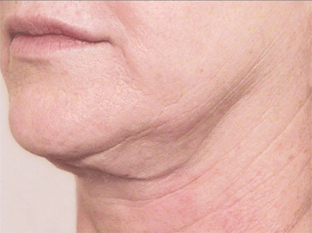 proven technology for firming the appearance of the neck