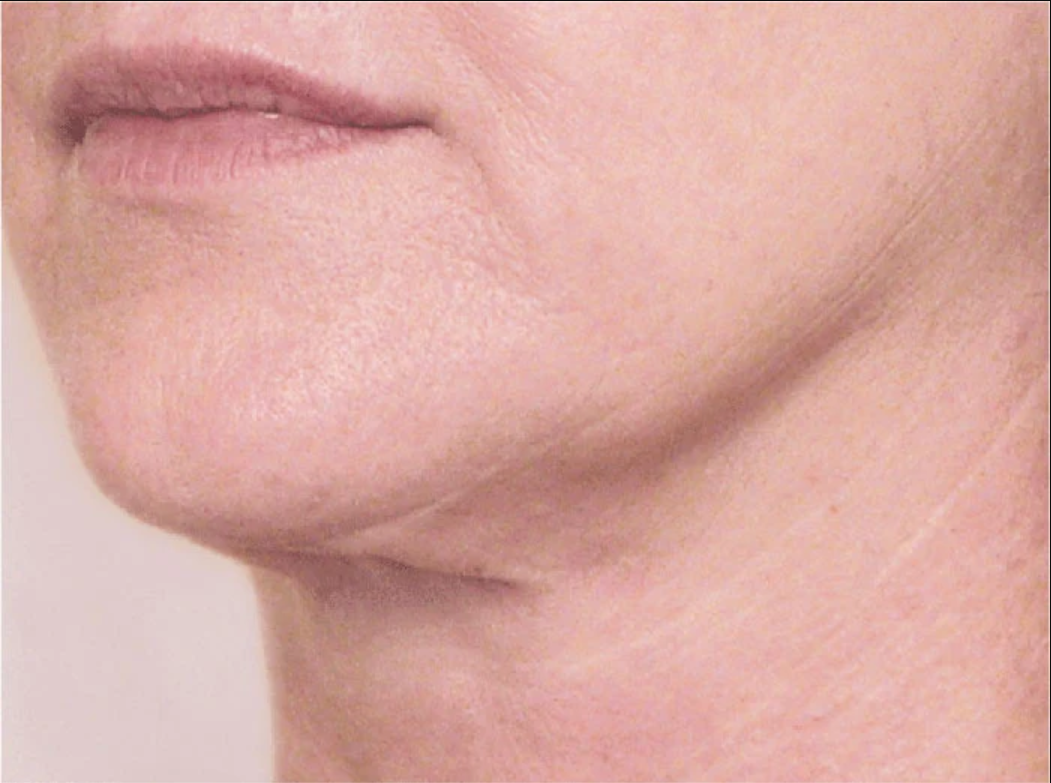 proven technology for firming the appearance of the neck