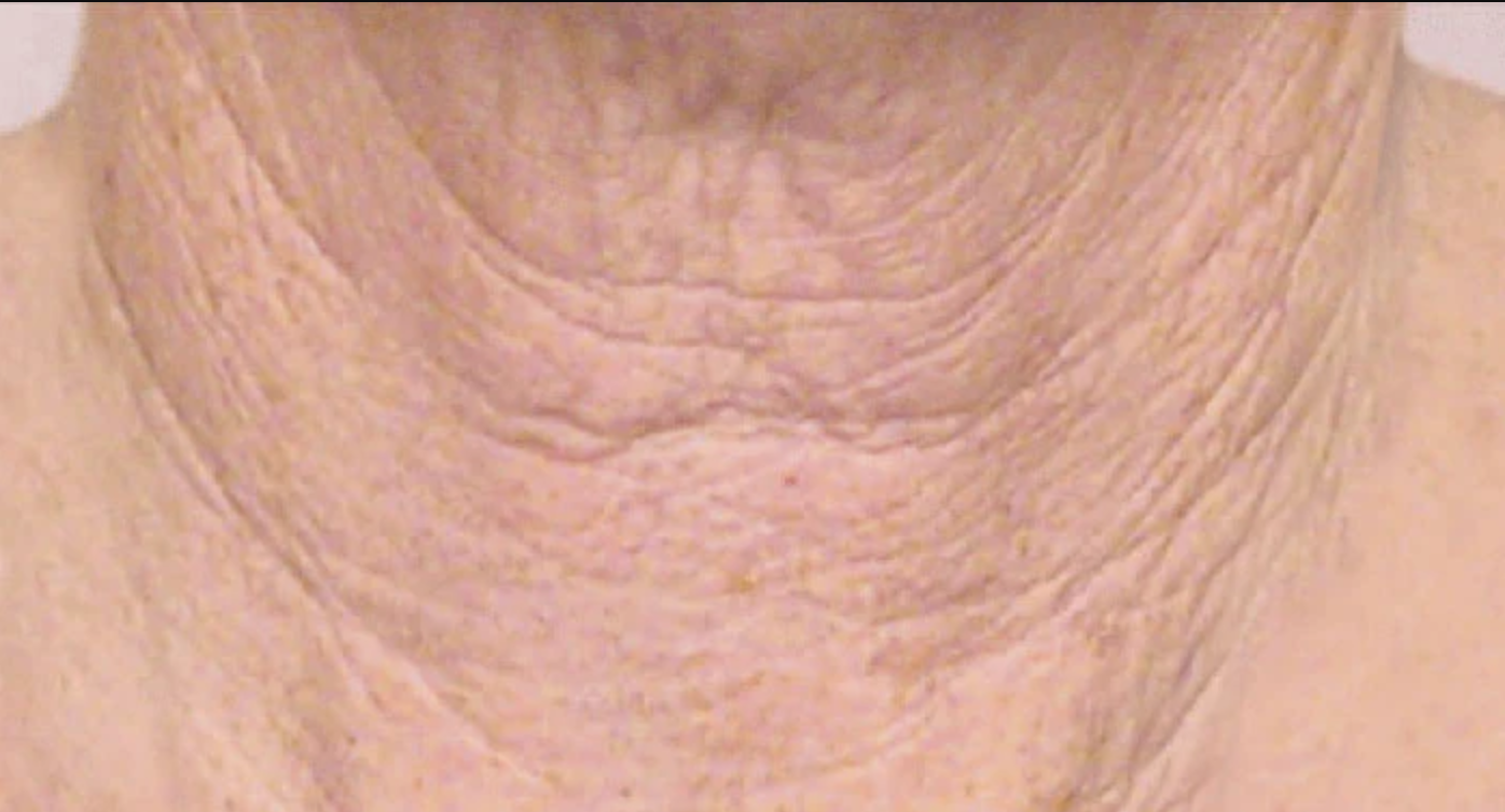 proven technology for firming the appearance of the neck