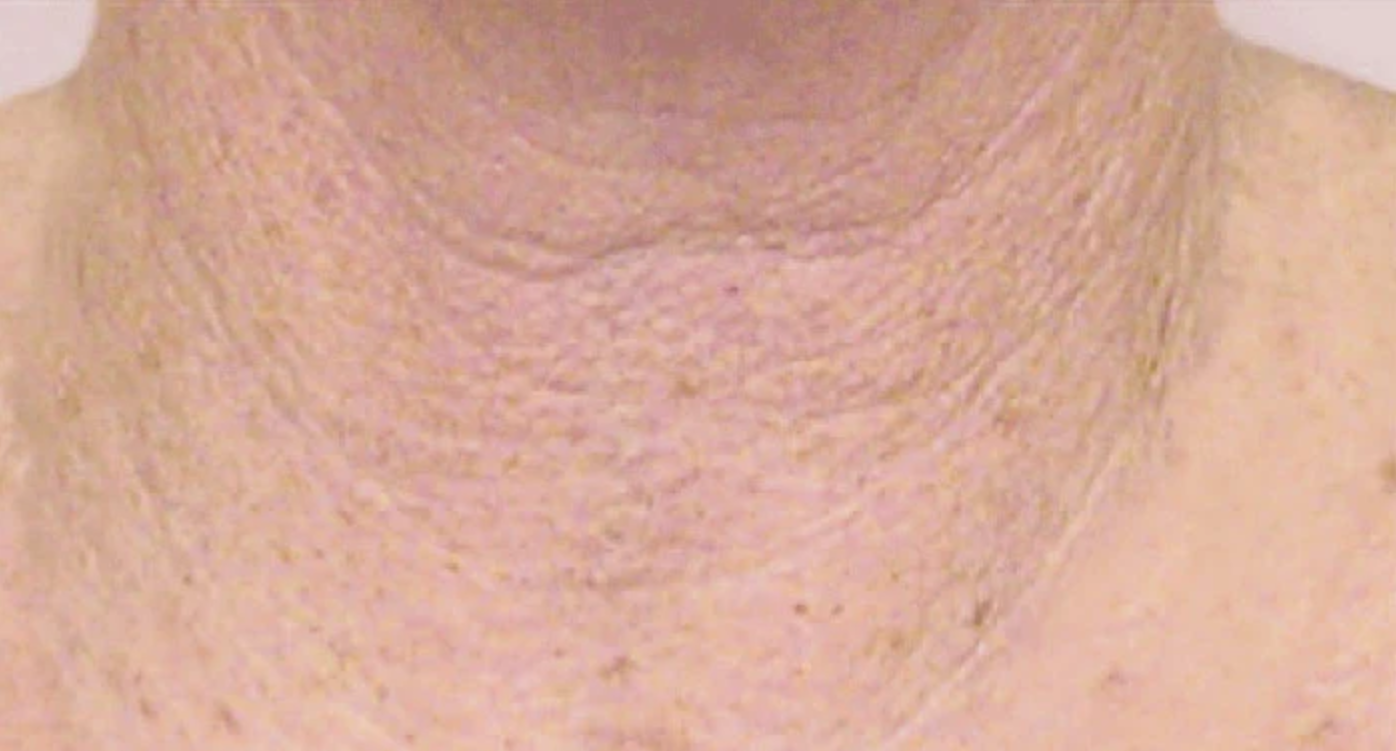 proven technology for firming the appearance of the neck