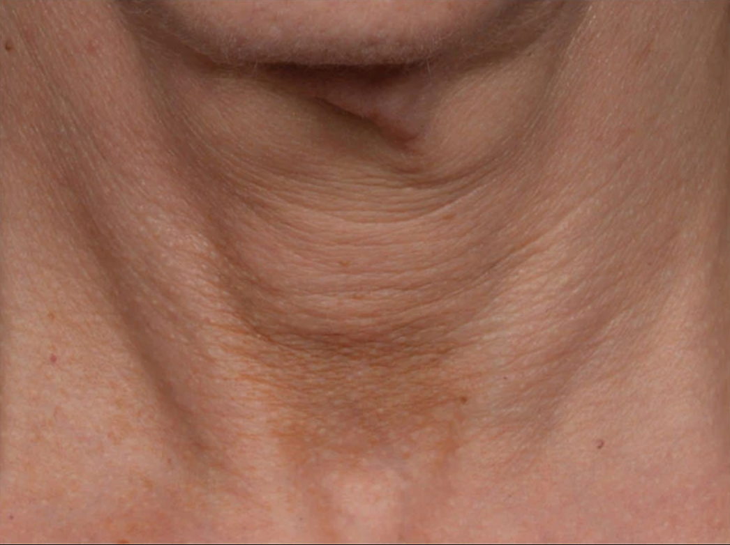 proven technology for firming the appearance of the neck