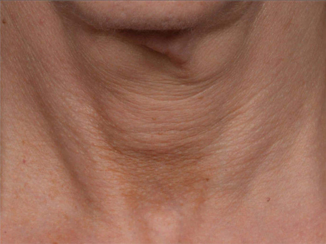 proven technology for firming the appearance of the neck