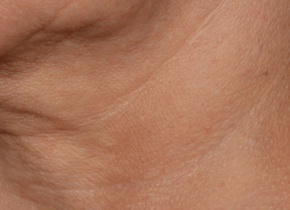 proven technology for firming the appearance of the neck