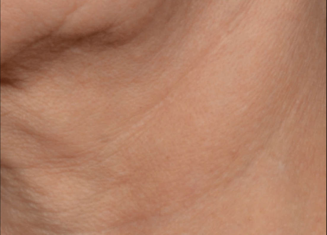 proven technology for firming the appearance of the neck