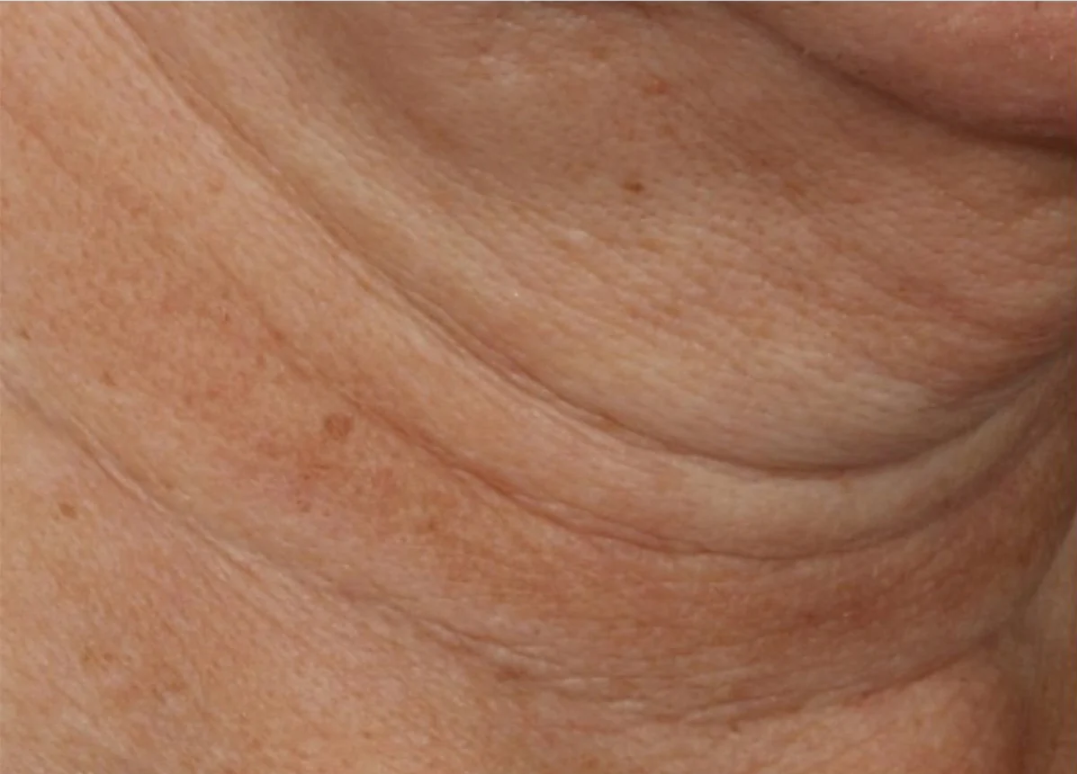 proven technology for firming the appearance of the neck