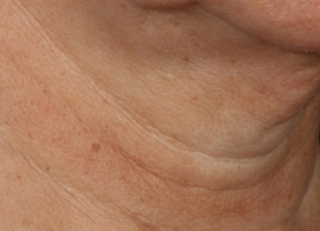proven technology for firming the appearance of the neck
