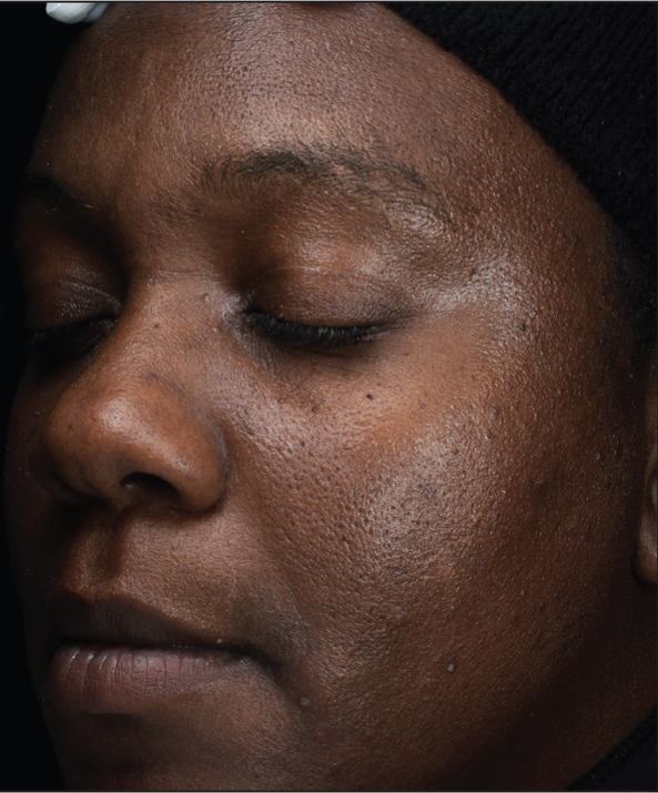 A powerhouse serum formulated with patent-pending Sunflower Sprout Extract Technology that has been clinically proven to impact the visible effects of glycation on skin