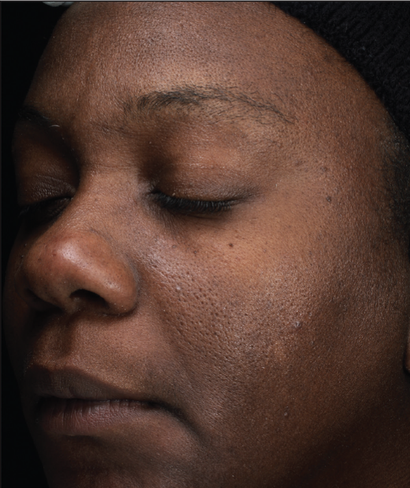 A powerhouse serum formulated with patent-pending Sunflower Sprout Extract Technology that has been clinically proven to impact the visible effects of glycation on skin