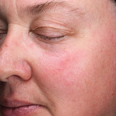 D·E·J Daily Boosting Serum®Before