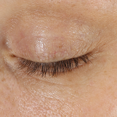 A close-up of a persons closed eye, showing detailed skin texture, eyelashes, and slight redness on the eyelid. After