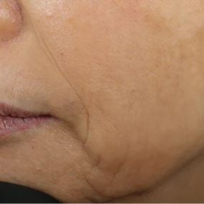 Close-up of the lower half of a persons face, showing visible wrinkles and fine lines on the cheek and around the mouth. The skin appears aged and textured.Before