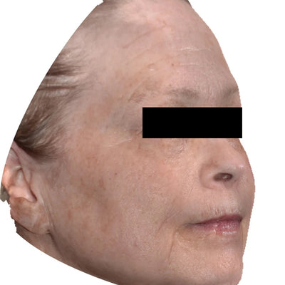 A close-up side view of an older womans face with light skin and light hair, showing wrinkles and age spots. Her eyes are covered by a black rectangular bar for privacy. After