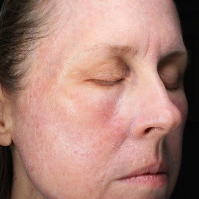 Close-up of a womans face with her eyes closed, showing dry, textured skin and some redness on the cheeks and forehead. She is under a bright light, with a headband holding her hair back. After