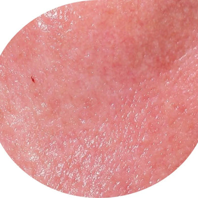 Close-up of pinkish, slightly shiny human skin with visible pores and a small red mark, highlighting texture and natural imperfections.Before