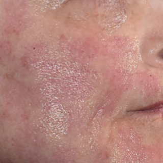 Close-up of a persons cheek and mouth showing dry, flaky, and red irritated skin, possibly due to a skin condition such as eczema or dermatitis.