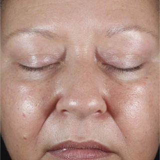 Close-up of a persons face with eyes closed, showing smooth and shiny skin, minimal visible eyebrows, and natural skin texture with some pores and small blemishes.