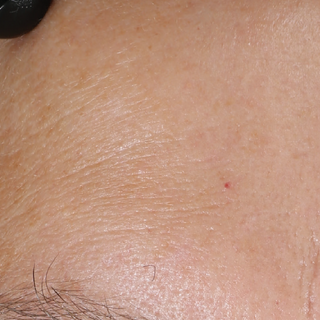 Close-up of a persons forehead showing skin texture, fine lines, and a small red blemish; part of a dark object is visible in the upper left corner.