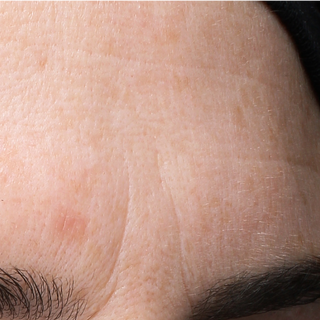 Close-up of a persons forehead and eyebrow, showing fine lines, skin texture, and a small red blemish above the brow. The image is well-lit, capturing details of the skin and hair.
