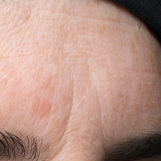 Close-up of a persons forehead, showing skin texture and fine lines. The top of an eyebrow is visible at the bottom of the image, and a dark fabric, possibly a hat, appears at the top.