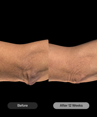 Side-by-side comparison of an elbow before and after 12 weeks using Revision Skincare BodiContour™, showing reduced wrinkles and smoother skin. Black background with labels "Before" and "After 12 Weeks" below each image.