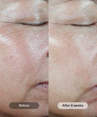 Close-up of a person’s cheek and eye area shows visible skin texture; left side labeled “Before,” right side labeled “After 8 weeks of Revision Skincare C+ Correcting Complex 30%®” with smoother, more even skin and fewer wrinkles.