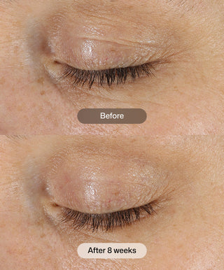 Close-up comparison of a closed eyelid before and after 8 weeks of using Revision Skincare D·E·J Eye Cream®. Before shows discoloration and roughness; after reveals smoother, firmer skin—ideal for under-eye rejuvenation.