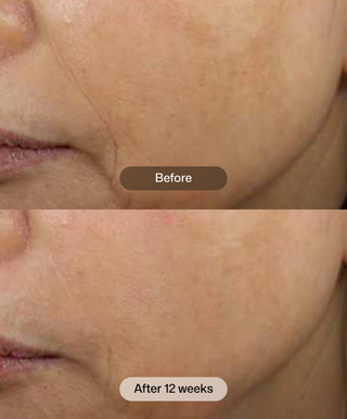 Close-up of a person's lower face comparing skin texture: the top image (Before) shows visible lines, while the bottom (After 12 weeks using Revision Skincare D·E·J Face Cream®) reveals smoother, firmer skin.