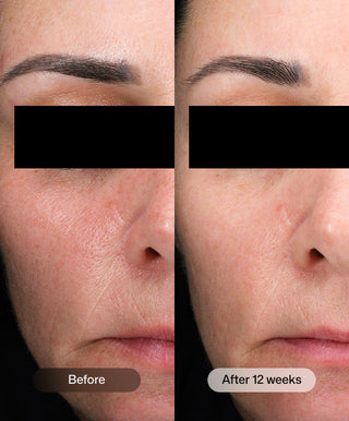Side-by-side close-up of a face shows firming results from Revision Skincare D·E·J Daily Boosting Serum®: Before shows uneven texture/redness; After 12 weeks reveals smoother, more even skin. Eyes are blacked out for privacy.