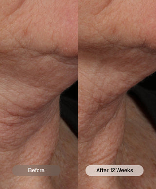 Side-by-side close-up of neck skin: Before with visible wrinkles, and After 12 weeks using Nectifirm® Advanced by Revision Skincare—skin appears smoother, firmer, and wrinkles are visibly reduced.