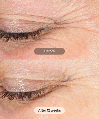Close-up of an eyelid with visible wrinkles before using Revision Skincare Revox™ Line Relaxer, and smoother skin with fewer wrinkles after 12 weeks, highlighting noticeable improvement over time.