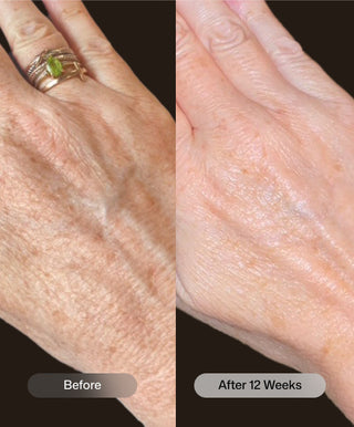 Side-by-side comparison of a hand before and after 12 weeks using YouthFull Hands™ by Revision Skincare, showing reduced wrinkles, smoother texture, and brighter skin. Rings are visible; the after image reveals a more youthful appearance.